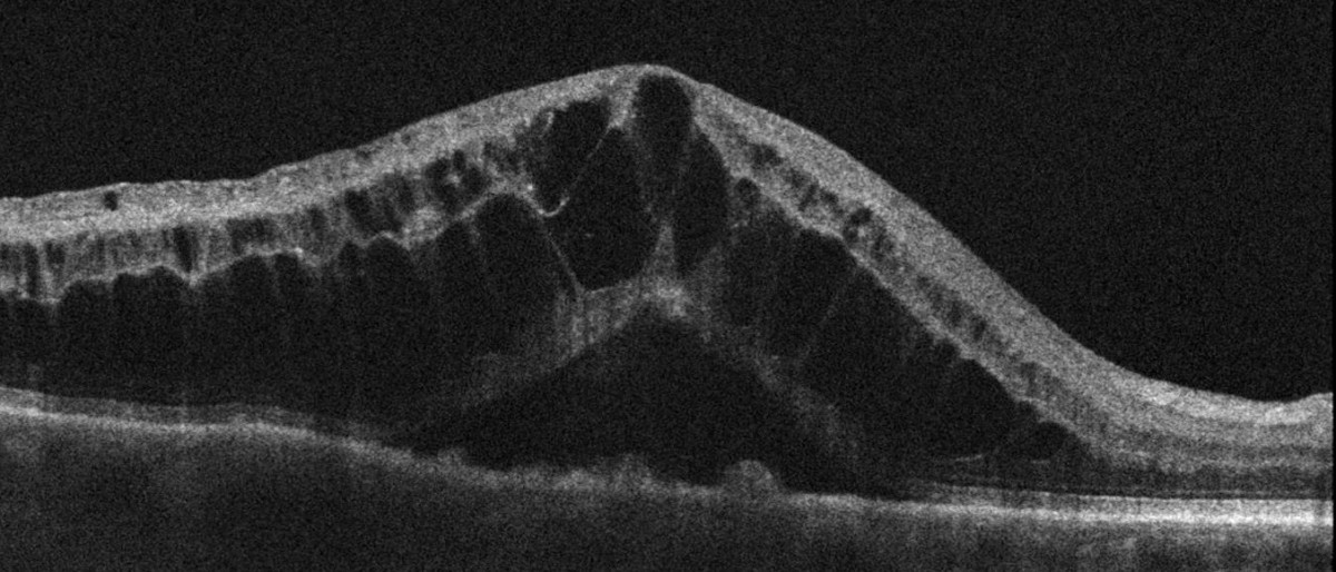 Various treatment for Macular Oedema Retina Doctor Melbourne