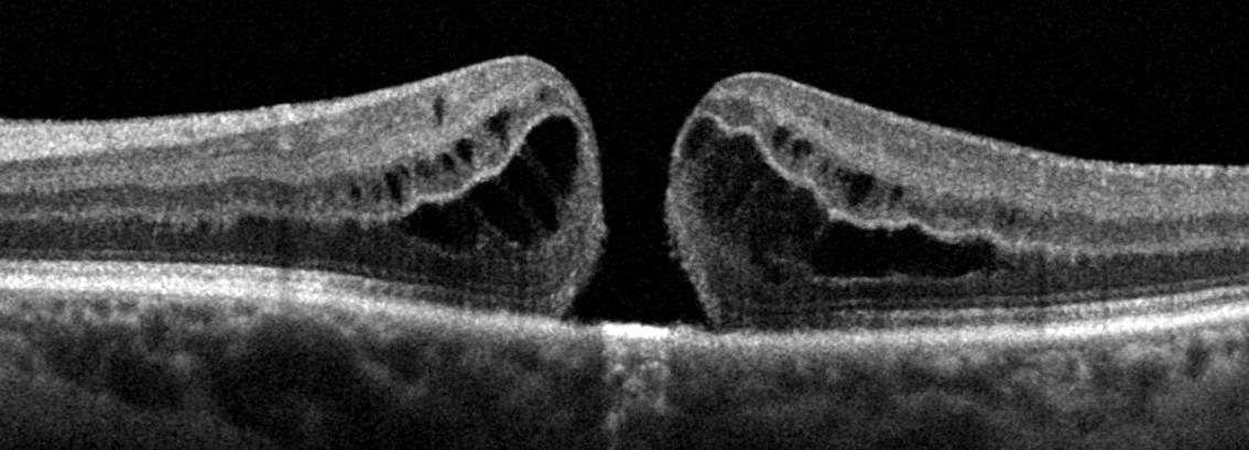 FTMH_edited_cropped - Retina Doctor