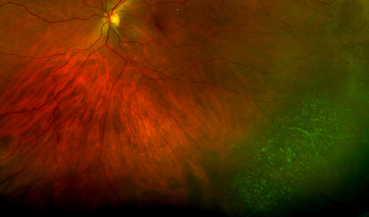 Retinoschisis Retinal Tear and Detachment Retina Doctor Melbourne