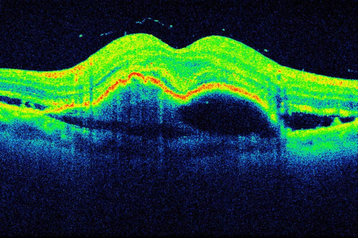 AMD_colour OCT_edited - Retina Doctor