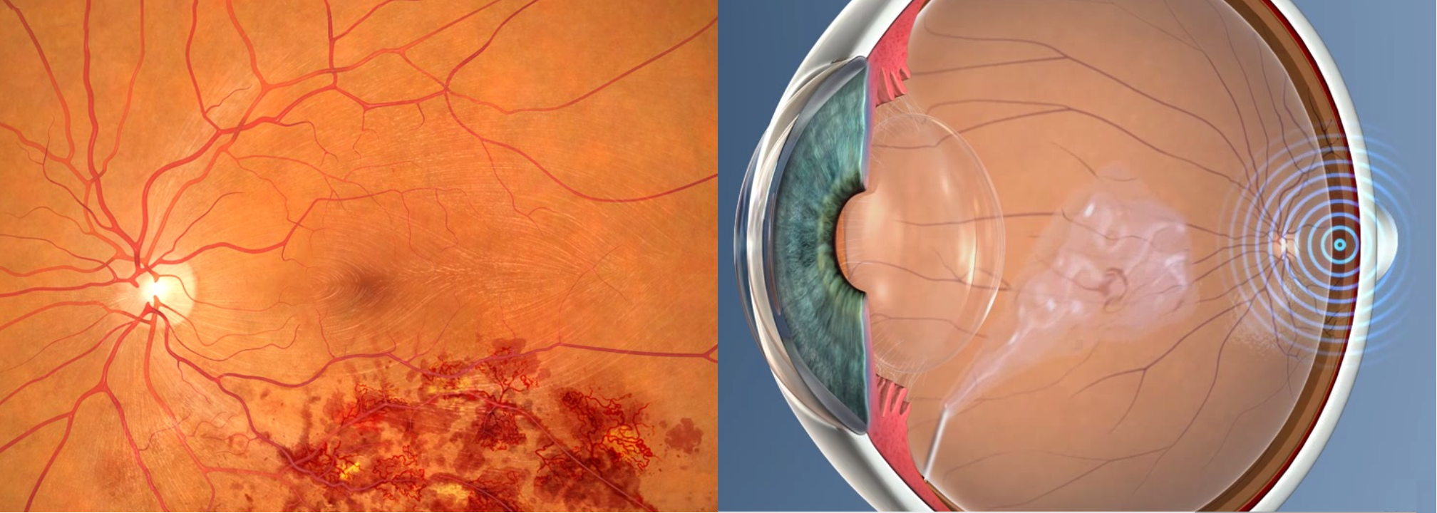 24. Intravitreal injections for retinal vein occlusion Retina Doctor